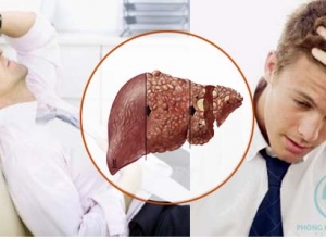 Viêm gan B cấp tính có chữa được không?